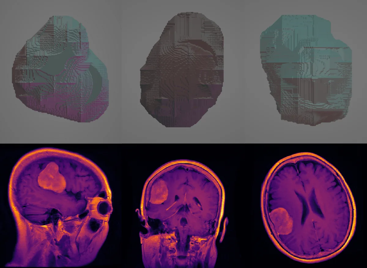 MRI slices compared with a reconstructed three-dimensional tumor