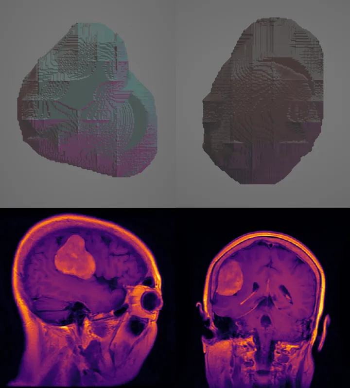 Three-dimensional tumor models and source MRI scans